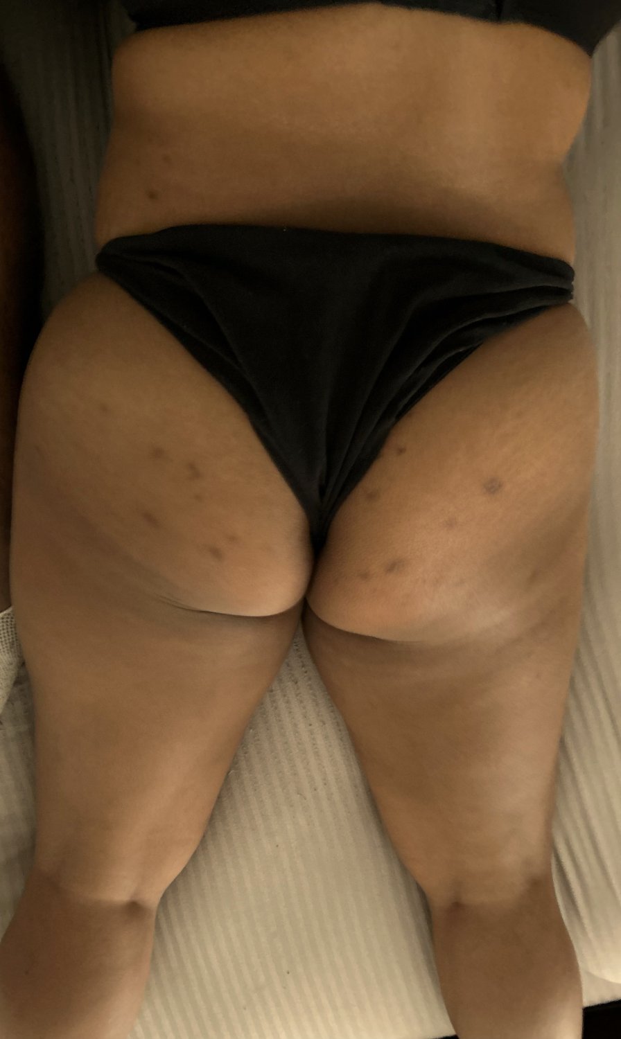 cellulite indian ass #5UXUT9YT